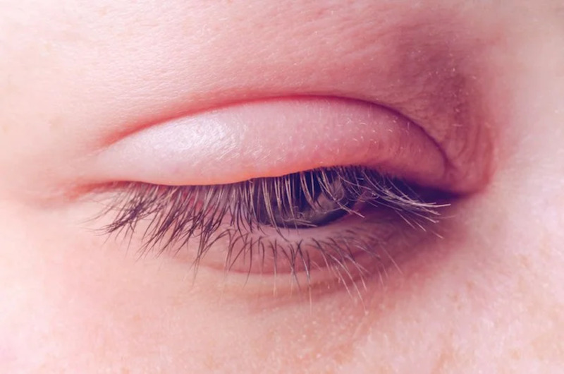 Kiến cắn sưng mí mắt có thể gây những biến chứng nguy hiểm cho mắt, thậm chí là gây mất thị lực vĩnh viễn